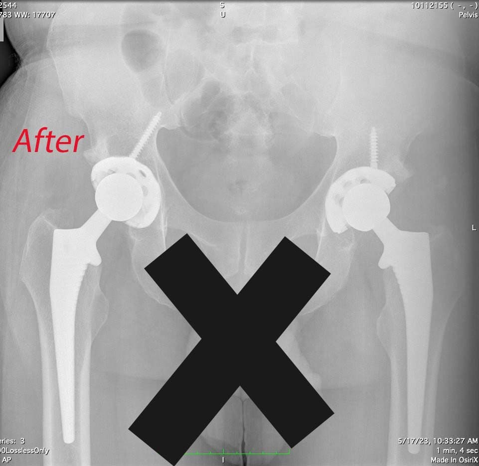 Joint Replacement